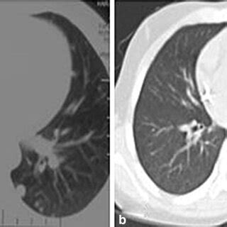 a CT scan showing nodules in bilateral lung parenchyma, suggestive of ...