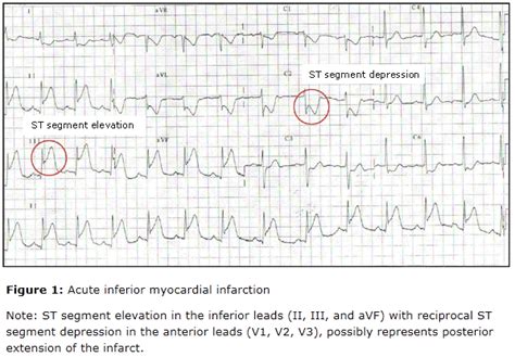 ST Segment Elevation - RCEMLearning India