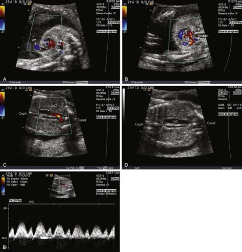 Ductus Venosus Pi Chart