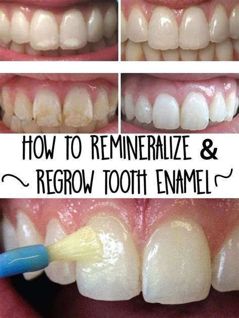 How to Remineralize & Regrow Tooth Enamel | Teeth health, Health tips, Health remedies