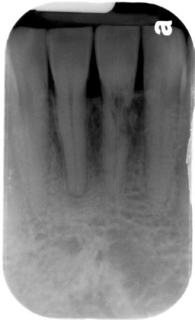 external resorption – Dr. G's Toothpix