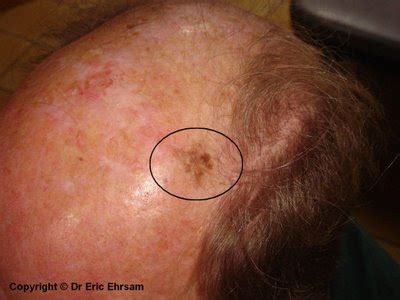 dermoscopy: scalp melanoma