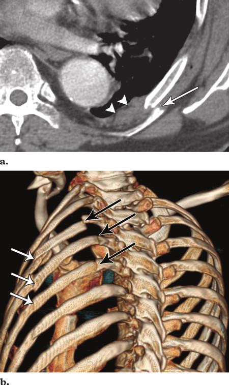 Rib fractures and flail chest. (a) CT scan shows a displaced left ...