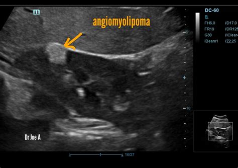 Ultrasound imaging: Angiomyolipoma-of-right-kidney