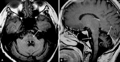 Brain MRI of a patient with multiple system atrophy, cerebellar form... | Download Scientific ...