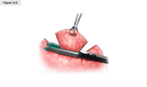 Open Wedge Resection | Thoracic Key