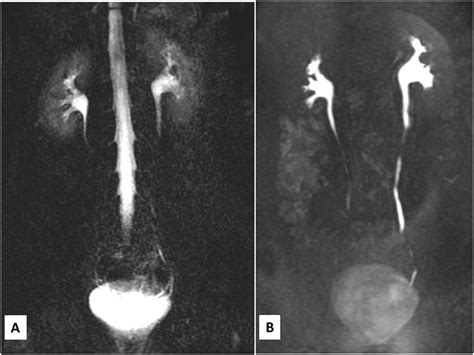 Pyogenic Granuloma: Possible Cause for Macroscopic Hematuria in Children - Urology