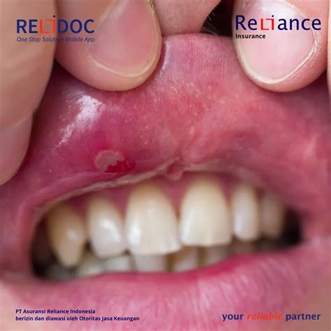 Stomatitis Herpes | ReliDoc - Asuransi Reliance Indonesia