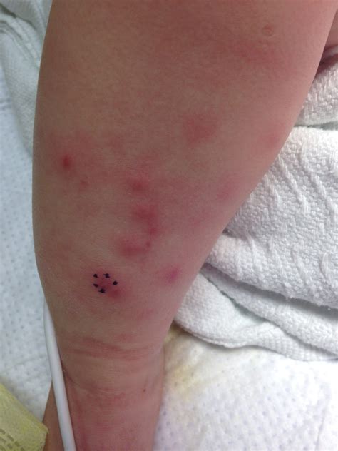 Pustular-vesicular lesions on extremities, trunk in infant female