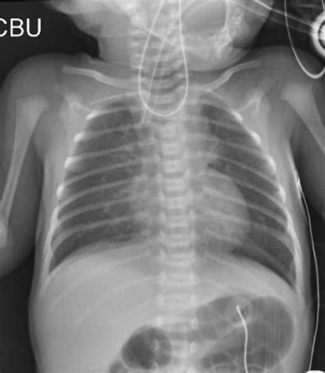 Oesophageal atresia with tracheo-oesophageal fistula: an unusual radiological presentation | ADC ...