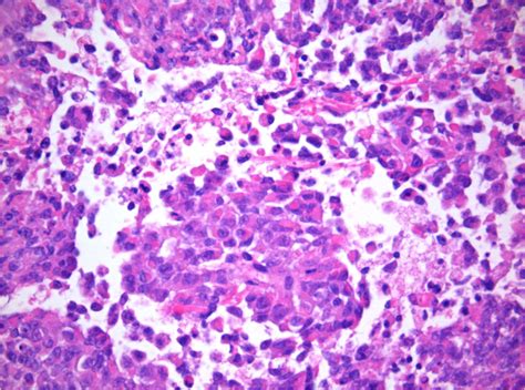 Atypical teratoid rhabdoid tumor - DocCheck