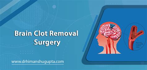 Brain Clot Removal Surgery in Jaipur - Dr. Himanshu Gupta