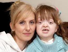 Pfeiffer Syndrome | Genetic disorders, Genetics, Prenatal development