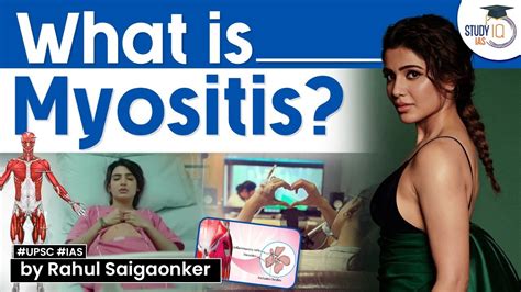 Actress Samantha diagnosed with Myositis. What is Myositis? UPSC ...