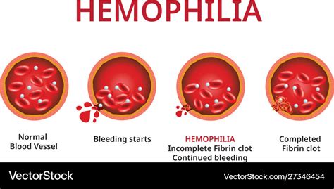 Hemophilia damaged blood vessel haemophilia Vector Image