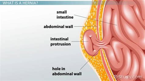 Incarcerated vs. Strangulated Hernia - Lesson | Study.com