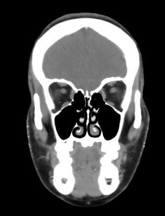 Torus palatinus | Radiology Case | Radiopaedia.org