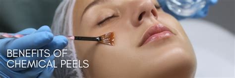 Benefits of chemical peels - The Cosmetic Centre