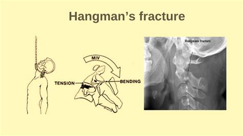 Hangman's Fracture |C2 fracture |Cervical spine fracture - YouTube