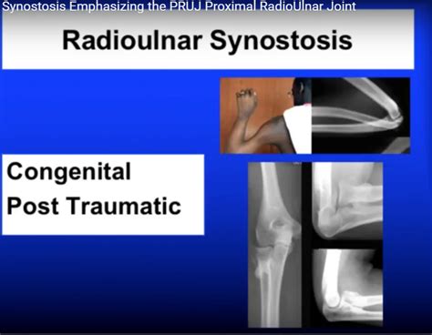 Radioulnar Synostosis — OrthopaedicPrinciples.com