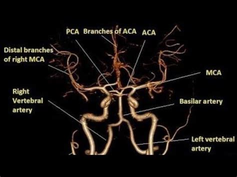 CT SCAN BRAIN AND NECK ANGIO - YouTube | Ct scan, Vertebral artery ...