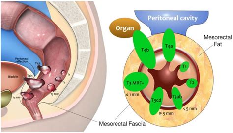 Perirectal Fat