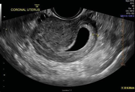 Two-dimensional ultrasonogram image of myometrial thickness ...