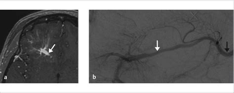 14 Developmental Venous Anomaly | Radiology Key