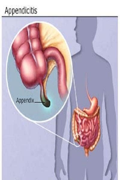 Appendix Cancer - CancerWalls