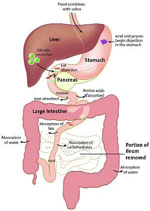 Short bowel syndrome. Causes, symptoms, treatment Short bowel syndrome