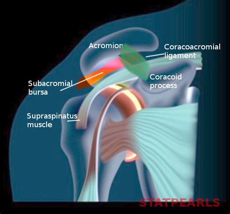 [Figure, Subacromial bursa Image courtesy S Bhimji MD] - StatPearls - NCBI Bookshelf