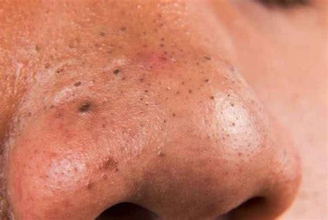 Infected Blackheads - Pictures, Symptoms, Causes, Treatment