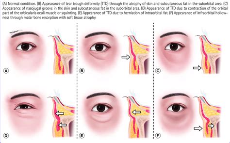 Causes of groove or hollowness | Download Scientific Diagram