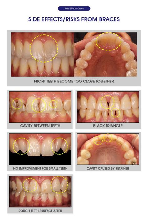 How Can I Get Perfect Teeth Alignment - (Dasha Taran)