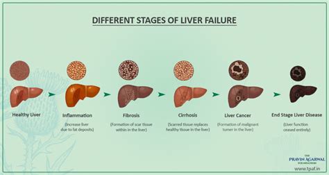 What Are The Different Stages Of Liver Failure?