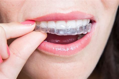 Orthodontic Retainers in Lewisville, TX | Castle Hills 3D Ortho