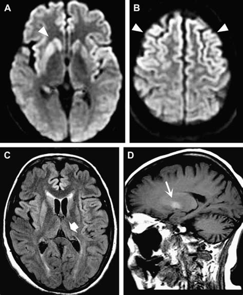 Prion Infections of the Brain | Radiology Key