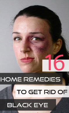 9 Popular Black eye remedies ideas | black eye remedies, remedies, eye black