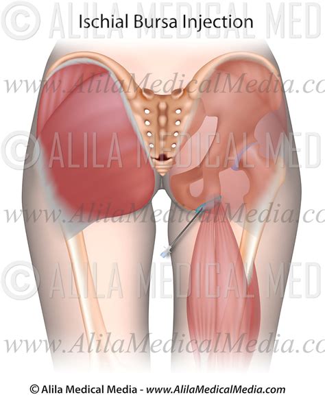 Ischial Bursitis