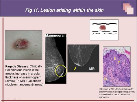 Figure 11 from Superficial breast lesions. A comprehensive review of ...