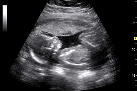 Ultrasound May Cut Thyroid Biopsy Rate - DistilNFO Provider