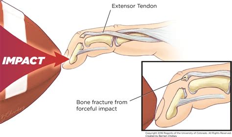 지골골절(phalanx fx.), 망치손가락(mallet finger), 견열골절(avulsion fx.), 류마티스 관절염 ...