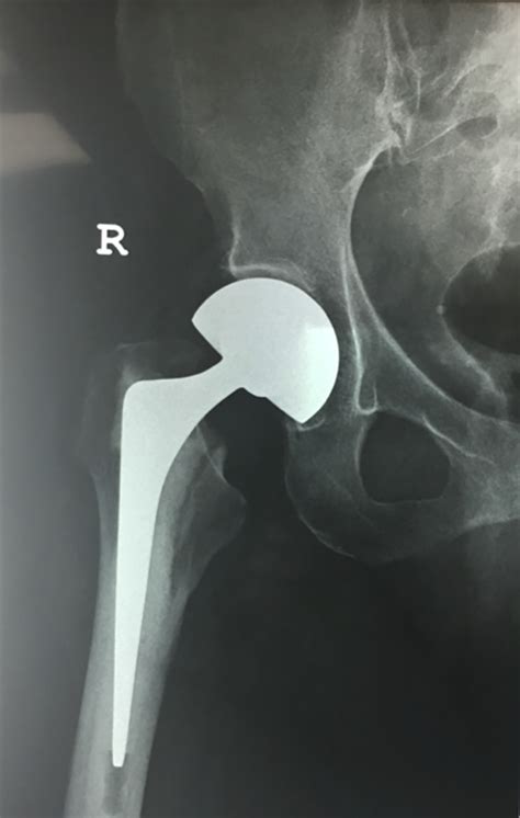 Bipolar Hip Hemiarthroplasty: What Is It And What To Expect, 41% OFF