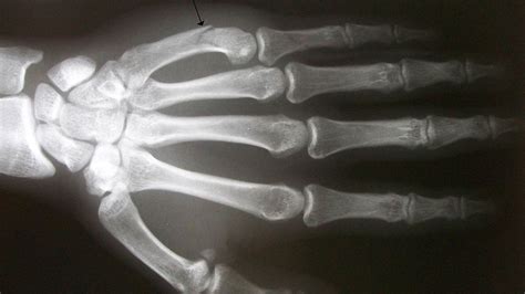 Broken Index Finger X Ray