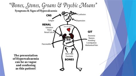 Hypercalcemia