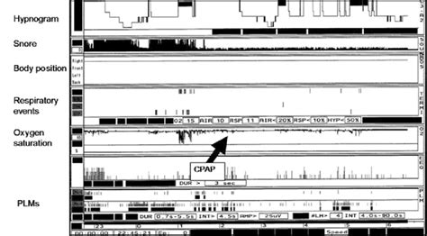 Split-night polysomnography recording in Case 2. The first part of the... | Download Scientific ...