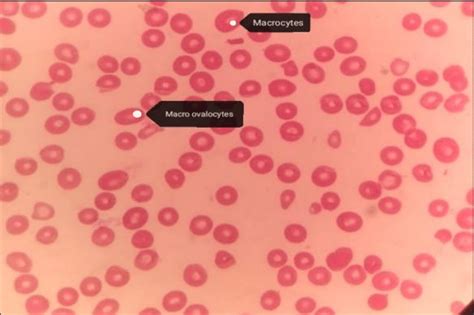 Peripheral smear showing macrocytic anaemia with macroovalocytes and... | Download Scientific ...