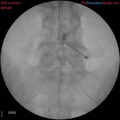 Interlaminar Lumbar Epidural Injection Lateral