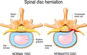 Herniated Disc Treatment and Symptoms | AllSpine