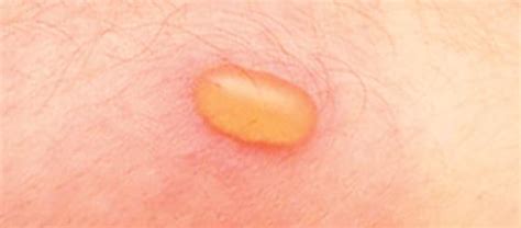 Blister Beetle Bite: Dermatitis and Rash Symptoms | Orkin